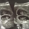 Trường hợp hiếm gặp tại khoa sản 2: Thai phụ chửa tam thai, hai thai trong tử cung và một thai ngoài tử cung