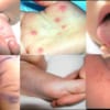 Bệnh tay – chân – miệng lây nhiễm thế nào?