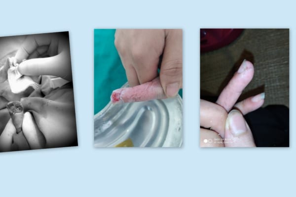 Điều trị mất da búp ngón tay bằng phương pháp băng kín, liền sẹo tự nhiên