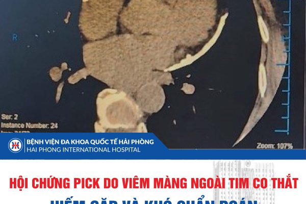 HỘI CHỨNG PICK DO VIÊM MÀNG NGOÀI TIM CO THẮT: HIẾM GẶP VÀ KHÓ CHẨN ĐOÁN