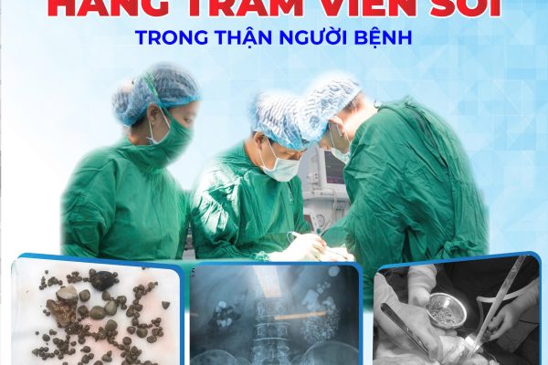 LOẠI BỎ HÀNG TRĂM VIÊN SỎI TRONG THẬN CHO NGƯỜI BỆNH