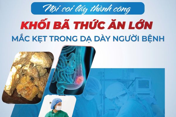 NỘI SOI LẤY THÀNH CÔNG KHỐI BÃ THỨC ĂN LỚN TRONG DẠ DÀY NGƯỜI BỆNH