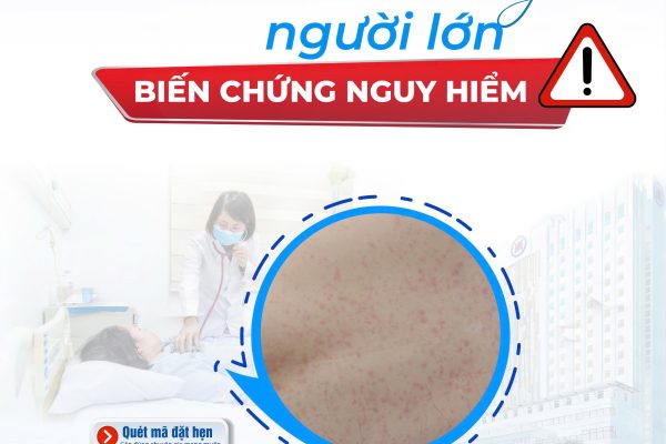 BỆNH SỞI “TẤN CÔNG” NGƯỜI LỚN VÀ NHỮNG BIẾN CHỨNG NGUY HIỂM