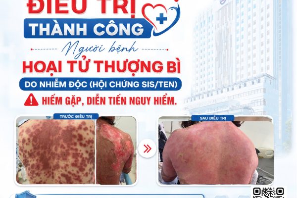 ĐIỀU TRỊ THÀNH CÔNG NGƯỜI BỆNH HOẠI TỬ THƯỢNG BÌ DO NHIỄM Đ.Ộ.C (HỘI CHỨNG SIS/TEN) HIẾM GẶP, DIỄN TIẾN N.G.U.Y H.I.Ể.M